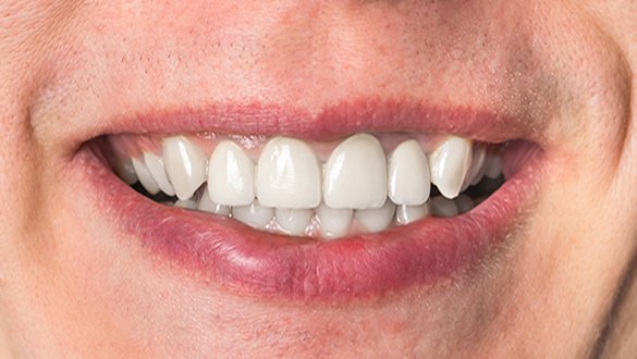 Teeth After Treatment